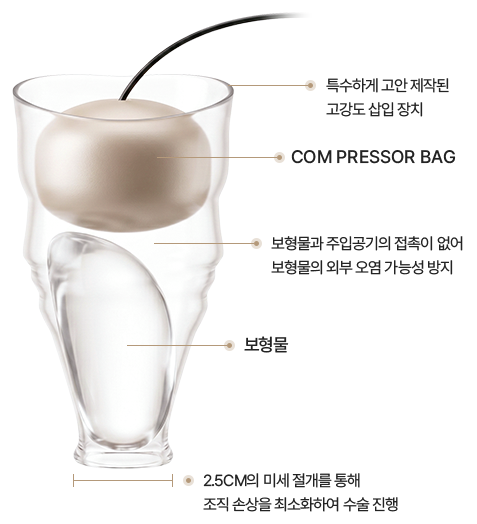 특수하게 고안 제작된 고강도 삽입 장치, Com pressor bag, 보형물과 주입공기의 접촉이 없어 보형물의 외부 오염 가능성 방지, 보형물, 2.5cm의 미세 절개를 통해 조직 손상을 최소화하여 수술 진행